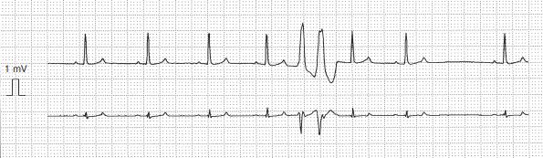 期外収縮の2連発